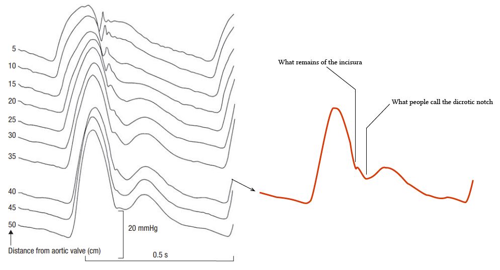 Normal arterial line waveforms Deranged Physiology